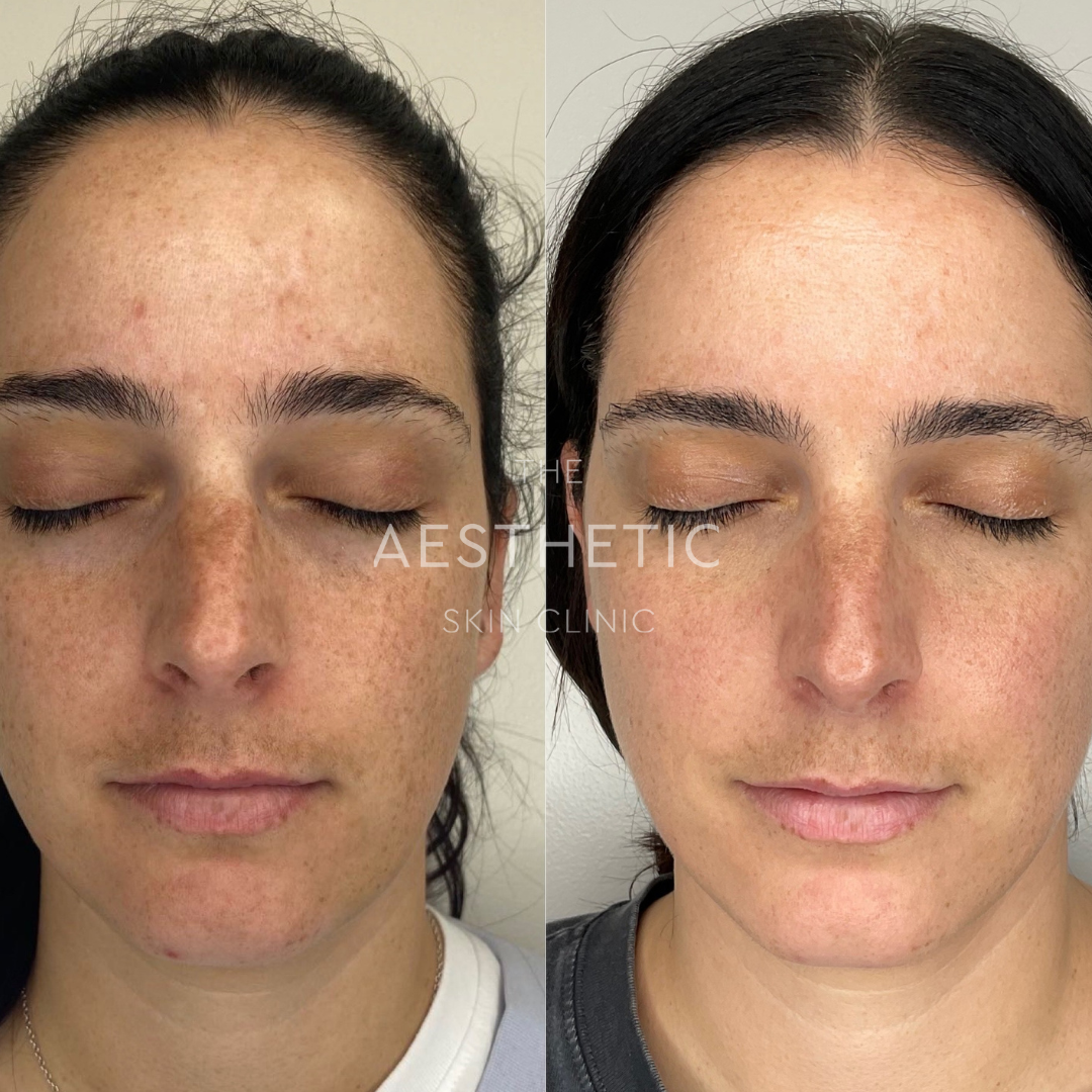 Melasma – Theaestheticskinclinic