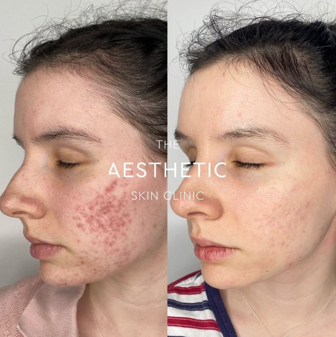 Results – Theaestheticskinclinic