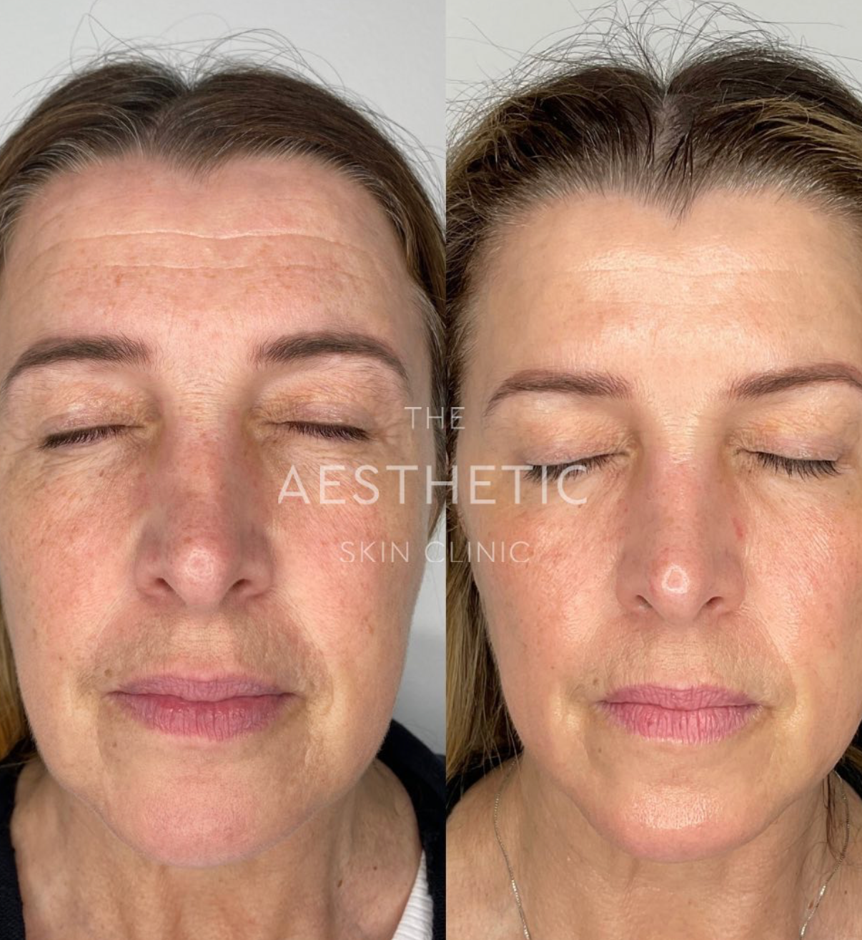 Results – Theaestheticskinclinic