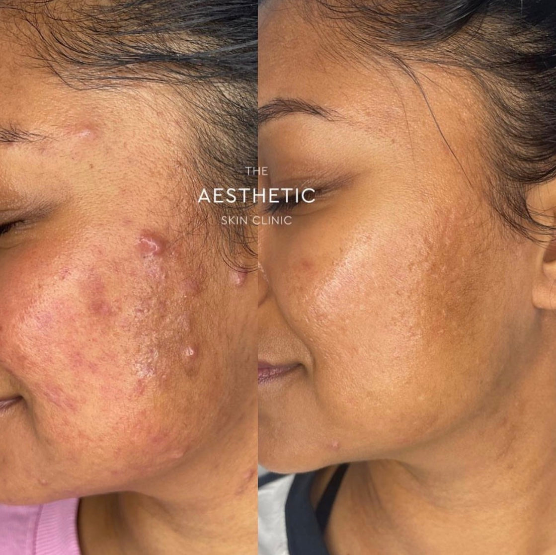 Acne Scars – Theaestheticskinclinic